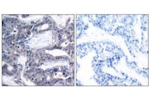 Immunohistochemical analysis of paraffin- embedded human breast carcinoma tissue using MEK2 (phospho-Thr394) antibody (E011008). (MEK2 antibody  (pThr394))