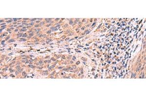 Immunohistochemistry of paraffin-embedded Human cervical cancer tissue using PER3 Polyclonal Antibody at dilution of 1:55(x200) (PER3 antibody)