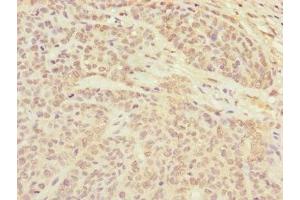 Immunohistochemistry of paraffin-embedded human ovarian cancer using ABIN7147357 at dilution of 1:100 (CETN3 antibody  (AA 1-167))