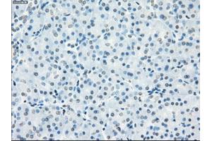 Immunohistochemical staining of paraffin-embedded Adenocarcinoma of breast tissue using anti-FCGR2A mouse monoclonal antibody.