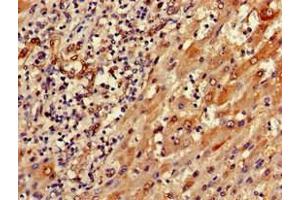 Immunohistochemistry of paraffin-embedded human liver cancer using ABIN7168819 at dilution of 1:100 (SEMA6A antibody  (AA 755-990))