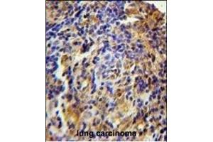 C Antibody (N-term) (ABIN654735 and ABIN2844423) immunohistochemistry analysis in formalin fixed and paraffin embedded human lung carcinoma followed by peroxidase conjugation of the secondary antibody and DAB staining.