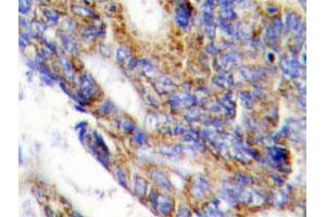 Immunohistochemical analysis of paraffin-embedded human colon cancer tissue using COL1A2 polyclonal antibody .