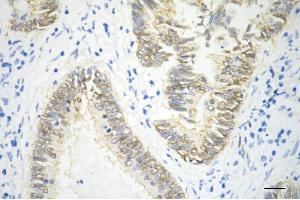 Immunohistochemistry was performed on paraffin-embedded human sigmoid colon carcinoma using catenin beta 1 antibody (ABIN7797925), 1:200). (CTNNB1 antibody)