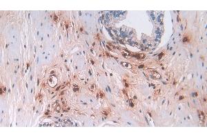 Detection of DEFa3 in Human Prostate Tissue using Polyclonal Antibody to Defensin Alpha 3, Neutrophil Specific (DEFa3) (DEFa3 antibody  (AA 21-94))