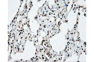 Immunohistochemical staining of paraffin-embedded Adenocarcinoma of ovary tissue using anti-DAPK2 mouse monoclonal antibody.