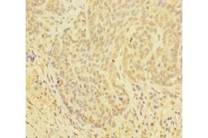 Immunohistochemistry of paraffin-embedded human ovarian cancer using ABIN7154046 at dilution of 1:100 (Glutaredoxin 1 antibody  (AA 1-106))
