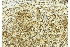 ABIN6278721 at 1/100 staining Human breast cancer tissue by IHC-P. (SUPT4H antibody  (C-Term))