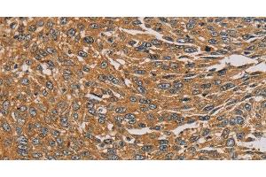Immunohistochemistry of paraffin-embedded Human lung cancer tissue using PARP11 Polyclonal Antibody at dilution 1:30 (PARP11 antibody)