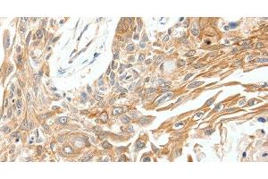 Immunohistochemistry of paraffin-embedded Human breast cancer tissue using SCN11A Polyclonal Antibody at dilution 1:40 (SCN11A antibody)