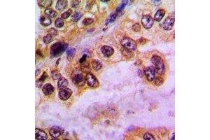 Immunohistochemical analysis of GABRD staining in human lung cancer formalin fixed paraffin embedded tissue section. (GABRD antibody)