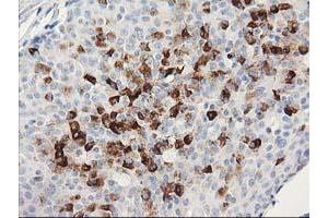 Immunohistochemical staining of paraffin-embedded Adenocarcinoma of Human breast tissue using anti-MGLL mouse monoclonal antibody. (MGLL antibody)