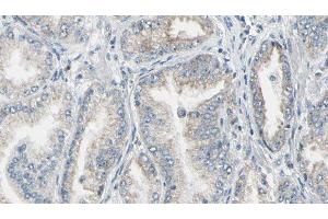 ABIN6276862 at 1/100 staining Human prostate tissue by IHC-P. (FKBP1A antibody  (N-Term))