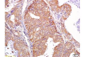 Formalin-fixed and paraffin embedded human breast carcinoma labeled with Rabbit Anti PALB2 Polyclonal Antibody, Unconjugated (ABIN670536) at 1:200 followed by conjugation to the secondary antibody and DAB staining (PALB2 antibody  (AA 1101-1186))