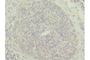 Immunohistochemistry of paraffin-embedded human cervical cancer using ABIN7159869 at dilution of 1:100 (Mtfp1 antibody  (AA 1-166))