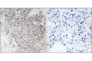 Immunohistochemistry analysis of paraffin-embedded human breast carcinoma, using p70 S6 Kinase (Phospho-Thr421) Antibody. (RPS6KB1 antibody  (pThr444))