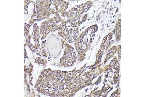 Immunohistochemistry of paraffin-embedded human esophageal cancer using METTL4 Rabbit pAb (ABIN6133091, ABIN6143773, ABIN6143774 and ABIN6224964) at dilution of 1:100 (40x lens).