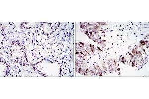 Immunohistochemical analysis of paraffin-embedded lung cancer (left) and ovary tumour tissues (right) using CCNB1 antibody with DAB staining. (Cyclin B1 antibody)