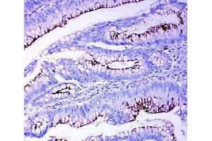IHC-P: Profilin 2 antibody testing of human intestinal cancer tissue (PFN2 antibody  (C-Term))