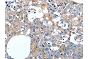 The image on the left is immunohistochemistry of paraffin-embedded Human breast cancer tissue using ABIN7191279(LILRB3 Antibody) at dilution 1/20, on the right is treated with synthetic peptide. (LILRB3 antibody)