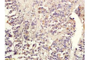 Formalin-fixed and paraffin embedded human colon carcinoma labeled with Anti-TGF-beta-2 Polyclonal Antibody, Unconjugated 1:300 followed by conjugation to the secondary antibody and DAB staining (TGF beta 2 Propeptide (AA 154-197) antibody)