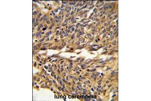 Formalin-fixed and paraffin-embedded human lung carcinoma reacted with EXOC5 Antibody , which was peroxidase-conjugated to the secondary antibody, followed by DAB staining. (EXOC5 antibody  (C-Term))