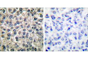 Peptide - +Immunohistochemical analysis of paraffin-embedded human breast carcinoma tissue using Catenin-γ antibody. (JUP antibody)