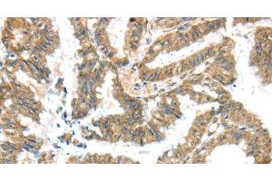 Immunohistochemistry of paraffin-embedded Human colon cancer tissue using KCNG3 Polyclonal Antibody at dilution 1:40