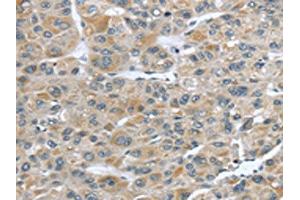 The image on the left is immunohistochemistry of paraffin-embedded Human liver cancer tissue using ABIN7190228(CFAP45 Antibody) at dilution 1/25, on the right is treated with synthetic peptide. (CCDC19 antibody)