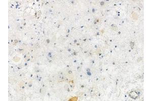 ABIN6256470 and ABIN6267347 at 1/100 staining human astrocytoma by IHC-P.
