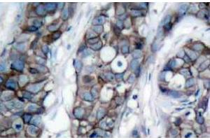 Immunohistochemistry (IHC) analyzes of p-HER2 (pTyr1248) pAb in paraffin-embedded human breast carcinoma tissue. (ErbB2/Her2 antibody  (pTyr1248))