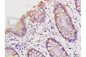 Formalin-fixed and paraffin embedded human colon carcinoma labeled with Anti-HMGA1/HMG-I/HMG-Y Polyclonal Antibody, Unconjugated (ABIN736626) at 1:200 followed by conjugation to the secondary antibody and DAB staining. (HMGA1 antibody  (AA 51-107))