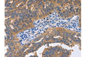 The image on the left is immunohistochemistry of paraffin-embedded Human ovarian cancer tissue using ABIN7191576(NBEA Antibody) at dilution 1/60, on the right is treated with synthetic peptide. (Neurobeachin antibody)