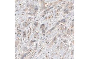 Immunohistochemical staining (Formalin-fixed paraffin-embedded sections) of human breast cancer with CDK5RAP2 monoclonal antibody, clone CL3392  shows centrosome-like immunoreactivity in tumor cells.