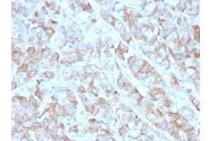 Formalin-fixed, paraffin-embedded human Gastric Carcinoma stained with CD269 / TNFRSF17 Mouse Monoclonal Antibody (BCMA/2366). (BCMA antibody  (AA 78-184))