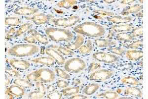 ABIN6261360 and ABIN6273231 at 1/100 staining Human kidney cancer and adjacent normal tissues by IHC-P.
