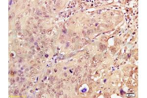 Formalin-fixed and paraffin embedded human breast carcinoma labeled with Anti-Dnmt3a Polyclonal Antibody, Unconjugated (ABIN669336) at 1:200, followed by conjugation to the secondary antibody and DAB staining (DNMT3A antibody  (AA 26-100))