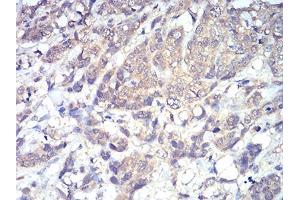 Immunohistochemical analysis of paraffin-embedded breast cancer tissues using PLCG1 mouse mAb with DAB staining. (Phospholipase C gamma 1 antibody  (AA 1192-1291))