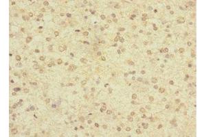 Immunohistochemistry of paraffin-embedded human glioma using ABIN7158190 at dilution of 1:100 (LRRC4C antibody  (AA 201-500))