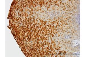 Immunoperoxidase of monoclonal antibody to KRTHB1 on formalin-fixed paraffin-embedded human esophagus. (KRT81 antibody  (AA 1-202))