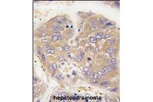 Formalin-fixed and paraffin-embedded human hepatocarcinoma tissue reacted with Dtnbp1 Antibody (N-term) (ABIN389169 and ABIN2839335) , which was peroxidase-conjugated to the secondary antibody, followed by DAB staining. (DTNBP1 antibody  (N-Term))