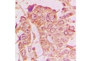 Immunohistochemical analysis of GRASP65 staining in human breast cancer formalin fixed paraffin embedded tissue section. (GORASP1 antibody)
