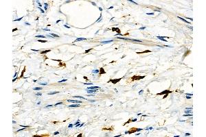 ABIN6261701 and ABIN6276667 at 1/100 staining Human ovarian cancer and adjacent normal tissues by IHC-P. (Fc gamma RII (CD32) (C-Term) antibody)