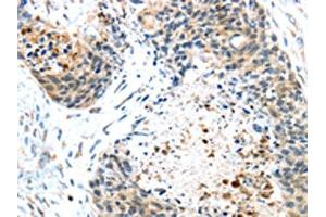 The image on the left is immunohistochemistry of paraffin-embedded Human esophagus cancer tissue using ABIN7131404(TMPRSS4 Antibody) at dilution 1/45, on the right is treated with fusion protein. (TMPRSS4 antibody)