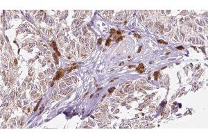 ABIN6275666 at 1/100 staining Human Melanoma tissue by IHC-P. (UEVLD antibody  (N-Term))