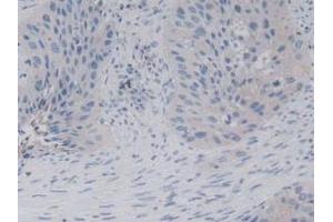 Detection of KLRD1 in Human Lung Cancer Tissue using Polyclonal Antibody to Killer Cell Lectin Like Receptor Subfamily D, Member 1 (KLRD1) (CD94 antibody  (AA 32-179))