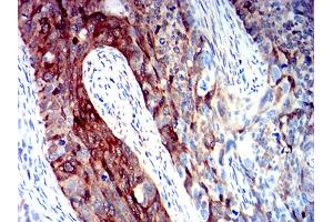 Immunohistochemical analysis of paraffin-embedded cervical cancer tissues using ALDH1A1 mouse mAb with DAB staining.