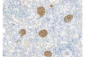 ABIN6260730 and ABIN6279282 at 1/100 staining Human kidney cancer and adjacent normal tissues by IHC-P.