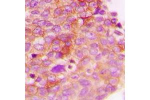 Immunohistochemical analysis of IRS1 (pS307) staining in human breast cancer formalin fixed paraffin embedded tissue section. (IRS1 antibody  (pSer307))