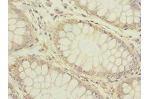 Immunohistochemistry of paraffin-embedded human colon cancer using ABIN7142631 at dilution of 1:100 (Serotonin Receptor 3B antibody  (AA 22-238))